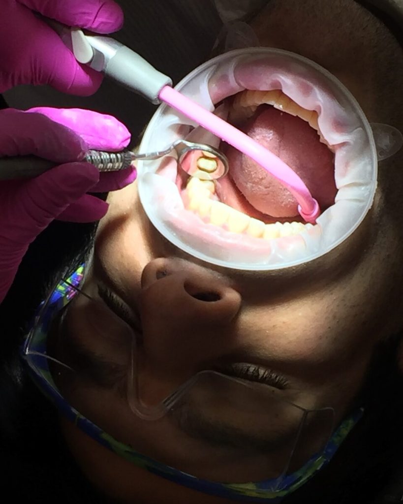 A patient wearing protective glasses during crown preparation, seen from above with the mouth held open by a retractor