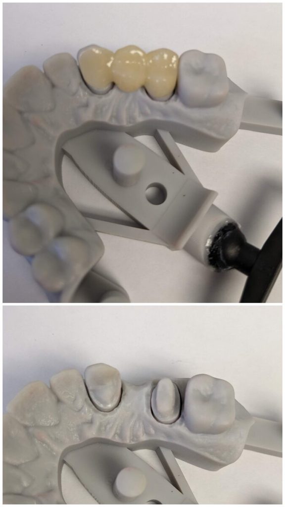 Before and after on a model of the teeth: two prepared teeth, then the three-unit ceramic bridge seated on them