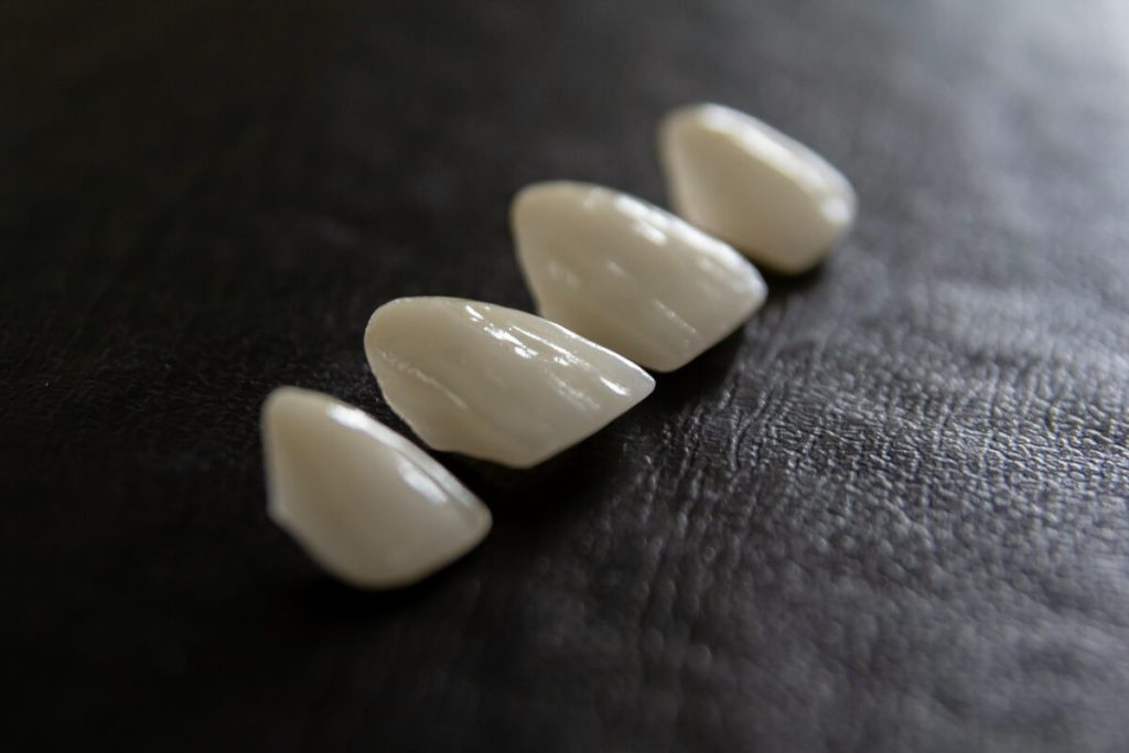 Four thin porcelain veneers lined up on a dark surface