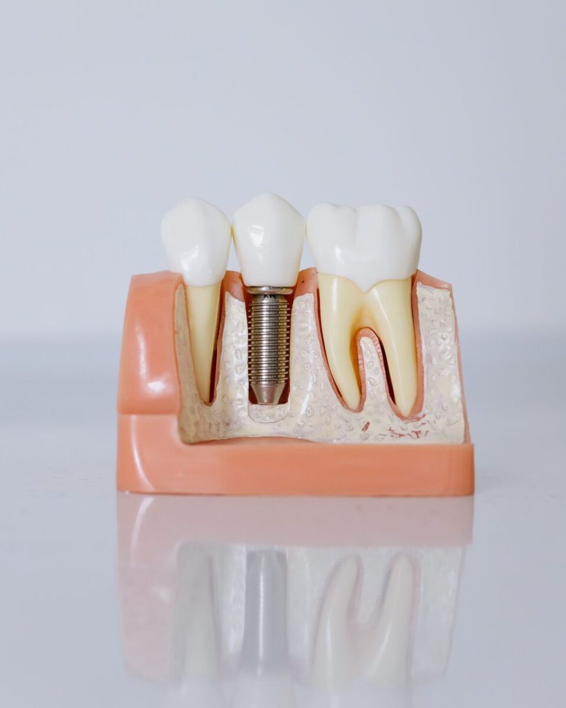 A cutaway model showing an implant with its crown between two natural teeth, roots in the bone